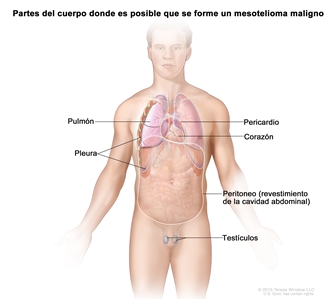 En la imagen se muestran las partes del cuerpo donde es posible que se forme un mesotelioma maligno, como la pleura (tejido que reviste la cavidad torácica y cubre los pulmones), el pericardio (tejido que rodea el corazón), el peritoneo (tejido que reviste el abdomen y cubre la mayoría de los órganos del abdomen) y los testículos. También se observan el corazón y los pulmones.