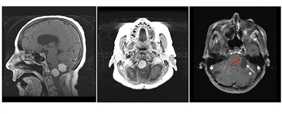 En la imagen se observan tres paneles. En el panel de la izquierda se muestra una vista sagital de dos lesiones prominentes de color claro en el tronco encefálico y el cerebelo. En el panel del medio se muestra una vista axial de una lesión prominente en el tronco encefálico. En el panel de la derecha se muestra una vista axial de una lesión en el cerebelo con un componente quístico que se ve como un área grande y oscura.