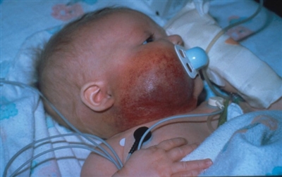 En la fotografía se muestra una lesión de hemangioendotelioma kaposiforme en el lado derecho de la cara y el cuello.