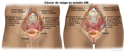 Cáncer de vejiga en estadio lllB. Se muestra una imagen con dos paneles. En el de la izquierda, se observa cáncer en un hombre y en el de la derecha, en una mujer. En ambos paneles, se observa cáncer en la vejiga y en más de un ganglio linfático que no está cerca de la arteria ilíaca común (a), así como en un ganglio linfático cerca de la arteria ilíaca común (b). También se muestran las arterias ilíacas comunes derecha e izquierda, la próstata (panel de la izquierda) y el útero (panel de la derecha).