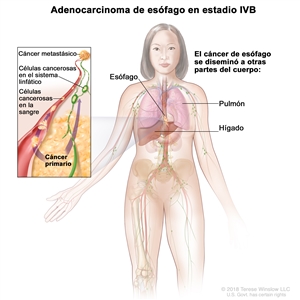 Adenocarcinoma de esófago en estadio IVB. En la imagen se observan otras partes del cuerpo donde se puede diseminar el cáncer de esófago, como el hígado y el pulmón. En un recuadro, se muestran células cancerosas que se diseminan desde el esófago, a través de la sangre y el sistema linfático, hasta otra parte del cuerpo en la que se formó el cáncer metastásico.