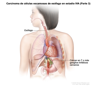 Carcinoma de células escamosas de esófago en estadio IVA (Parte 3). En la imagen se observa cáncer en el esófago y en 9 ganglios linfáticos cercanos.