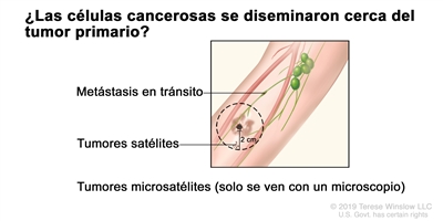 Estadificación del melanoma (metástasis en tránsito, tumores satélites y tumores microsatélites). En el dibujo se observan metástasis en tránsito en un vaso linfático a más de 2 cm del tumor primario y tumores satélites a 2 cm o menos del tumor primario. No se muestran los tumores microsatélites porque solo se ven con un microscopio.