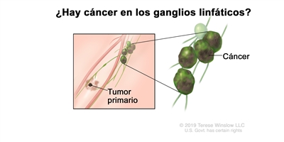 Estadificación del melanoma (compromiso de ganglios linfáticos). En el dibujo se observa un cáncer que se diseminó desde el tumor primario hasta los ganglios linfáticos.