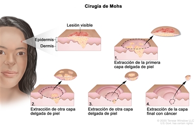 Cirugía de Mohs. En la imagen se observa un paciente con cáncer de piel en la cara. En la ampliación se muestra un trozo de piel con un cáncer en la epidermis (capa exterior de la piel) y la dermis (capa interna de la piel). También se muestra una lesión visible en la superficie de la piel. En cuatro ampliaciones numeradas se observa la extracción de capas delgadas de la piel, una por una hasta que se termina de extirpar todo el cáncer.