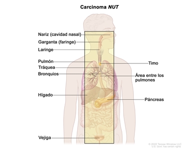 En la imagen se observan las áreas donde es posible que se forme el carcinoma NUT, como la nariz (cavidad nasal), la garganta (faringe), la laringe, el pulmón, el timo, la tráquea, los bronquios, el área entre los pulmones, el hígado, el páncreas y la vejiga.