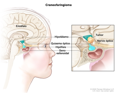 Imagen del interior del encéfalo en la que se muestra dónde se forman los craneofaringiomas. En el recuadro se observa un tumor entre el hipotálamo y el quiasma óptico. También se muestran el nervio óptico, la hipófisis y el seno esfenoidal.