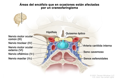 En el dibujo se observa una vista frontal de áreas del encéfalo que en ocasiones están afectadas por un craneofaringioma, como la hipófisis y el quiasma óptico. Además, se muestra el nervio motor ocular común (III), el nervio troclear (IV), el nervio motor ocular externo (VI), el nervio oftálmico (V1), el nervio maxilar (V2), la arteria carótida interna, un seno cavernoso y los senos esfenoidales.