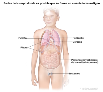 En la imagen se muestran las partes del cuerpo donde es posible que se forme un mesotelioma maligno, como la pleura (tejido que reviste la cavidad torácica y cubre los pulmones), el pericardio (tejido que rodea el corazón), el peritoneo (tejido que reviste el abdomen y cubre la mayoría de los órganos del abdomen) y los testículos. También se observan el corazón y los pulmones.