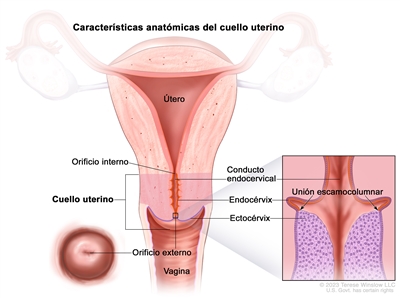 En el dibujo se observan las aracterísticas anatómicas del cuello uterino. Se muestran el orificio interno, el conducto endocervical, el endocérvix, el ectocérvix y el orificio externo. También se observan el útero y la vagina. Además, en un recuadro se muestra una vista de cerca de la unión escamocolumnar (área donde el endocérvix se une al ectocérvix) y las células que revisten el endocérvix y el ectocérvix.