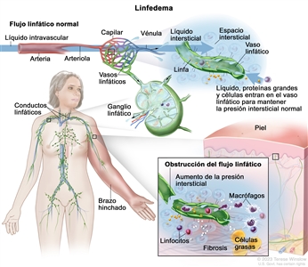 Linfedema. En la parte superior del dibujo se observa un flujo linfático normal y una flecha indica la dirección del flujo del líquido intravascular a través de una arteria, una arteriola y un lecho capilar, donde el líquido pasa al espacio intersticial que rodea las células y sale a través de las vénulas. También se muestra el líquido intersticial, proteínas grandes y células alrededor de un vaso linfático y se señala que entran al vaso para mantener la presión intersticial normal. El líquido dentro del vaso linfático se llama linfa. Asimismo, se observa la estructura interna de un ganglio linfático unido a un vaso linfático y flechas que indican cómo la linfa entra y sale del ganglio linfático. Además, se ven conductos linfáticos en el área del cuello de una figura de mujer, cuyo brazo izquierdo está enrojecido e hinchado. Hay una ampliación del brazo hinchado que muestra una sección de la superficie de la piel que está enrojecida y endurecida. En un recuadro se ve la obstrucción del flujo linfático y un vaso linfático dañado que provoca aumento de la presión intersticial y acumulación de proteínas grandes, restos celulares, macrófagos y linfocitos. En el recuadro también se observan células grasas (adipocitos) grandes y fibrosis.