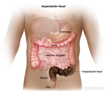 Impactación fecal. En el dibujo se muestra una masa de heces de color marrón oscuro en la última parte del colon y en el recto. También se muestran el estómago, el intestino delgado y el ano.