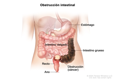 En el dibujo del abdomen de una persona adulta se muestra una obstrucción intestinal, con una masa grande de materia fecal de color marrón oscuro en el intestino grueso causada por el bloqueo de un tumor. El tumor se encuentra en la porción final del intestino grueso justo antes del recto. También se señalan otras partes del tubo digestivo, como el estómago, el intestino delgado, el recto y el ano.