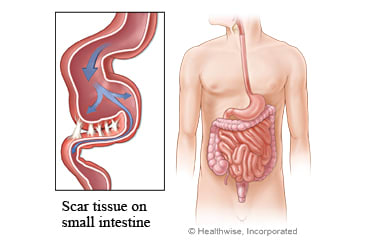 Adhesions on the small intestine.