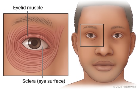 An eye, showing the muscles around it and the cornea, or eye surface