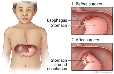 Location of esophagus and stomach, with detail of how they look before and after surgery.