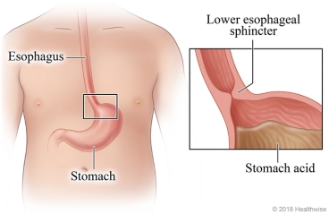 Location of lower esophageal sphincter between esophagus and stomach, with detail of the sphincter and stomach acid.