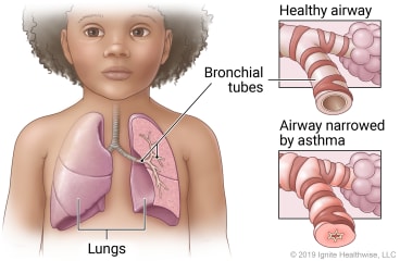 Location of the lungs and bronchial tubes, with detail of a healthy airway vs. an airway narrowed by asthma