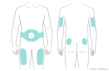 Locations on body for giving insulin shots, including belly at least 2 in. from navel, front of thighs, back of upper arms, and upper buttocks. Locations on body for giving insulin shots, including belly at least 2 in. from navel, front of thighs, back of upper arms, and upper buttocks.