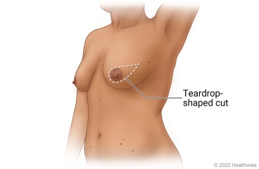 Breast showing incision site for skin-sparing mastectomy with teardrop cut around the areola. Breast showing incision site for skin-sparing mastectomy with teardrop cut around the areola.