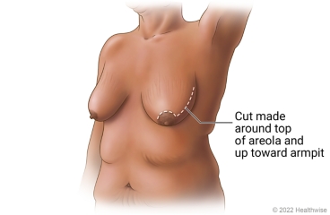 Breast showing incision site for nipple-sparing mastectomy with periareolar cut, a cut around top of areola and up toward armpit. Breast showing incision site for nipple-sparing mastectomy with periareolar cut, a cut around top of areola and up toward armpit.