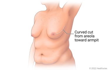 Breast showing incision site for nipple-sparing mastectomy, a curved cut from areola toward armpit. Breast showing incision site for nipple-sparing mastectomy, a curved cut from areola toward armpit.