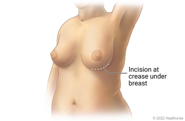 Breast showing incision site at crease under breast for nipple-sparing mastectomy with inframammary cut. Breast showing incision site at crease under breast for nipple-sparing mastectomy with inframammary cut.