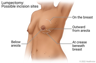 Possible incision sites for lumpectomy, including on the breast, below areola, outward from areola, and at crease beneath breast. Possible incision sites for lumpectomy, including on the breast, below areola, outward from areola, and at crease beneath breast.
