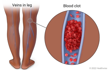 Back of child's leg showing veins in leg, with detail of blood clot inside vein.