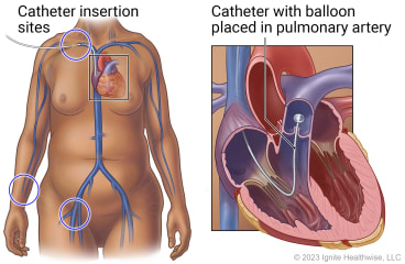 Body showing heart and catheter insertion sites at neck, groin, and wrist, with detail of catheter placed in pulmonary artery with inflated balloon at end.