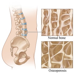 Picture of normal bone vs. bone with osteoporosis