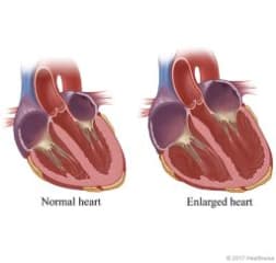 Cross section of a normal heart and a heart with enlarged chambers.