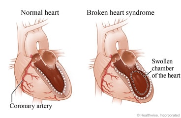 A normal heart showing a coronary artery and a normal chamber, and a heart with broken heart syndrome showing a swollen chamber.