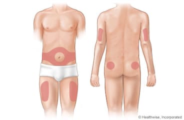 Areas of the body where insulin can be given.