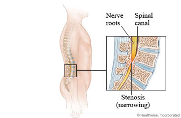 Skeletal view of spine, with detail of narrowed spinal canal in the lower back