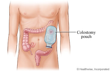 Colostomy pouch