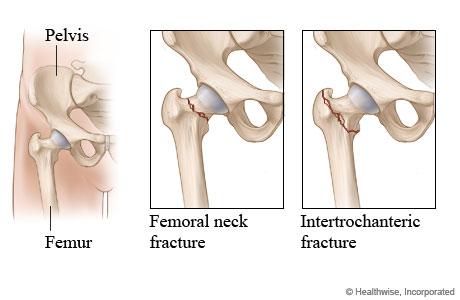 Two types of hip fracture