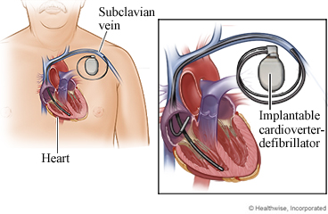 An ICD with wires going into the heart chambers