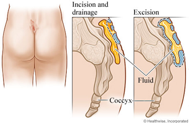 Abscessed pilonidal cyst at top of crease between buttocks, with detail of cyst cut open and drained, and detail of cyst removed.