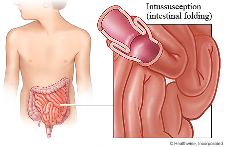 Picture of intussusception