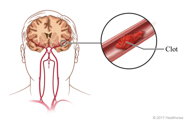 The brain with detail of clot in a blood vessel.