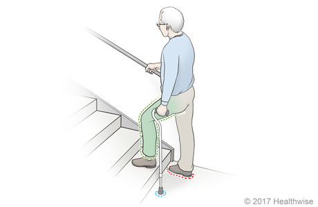 Going up stairs with a cane. Going up stairs with a cane.