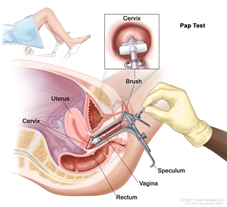 Pap test; drawing shows a side view of the female reproductive anatomy during a Pap test. A speculum is shown widening the opening of the vagina. A brush is shown inserted into the open vagina and touching the cervix at the base of the uterus. The rectum is also shown. One inset shows the brush touching the center of the cervix. A second inset shows a woman covered by a drape on an exam table with her legs apart and her feet in stirrups.