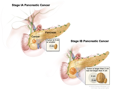 Stage I pancreatic cancer; drawing on the left shows stage IA pancreatic cancer. The cancer is in the pancreas and the tumor is 2 centimeters or smaller. An inset shows 2 centimeters is about the size of a peanut. The drawing on the right shows stage IB pancreatic cancer. The cancer is in the pancreas and the tumor is larger than 2 centimeters but not larger than 4 centimeters. An inset shows 2 centimeters is about the size of a peanut and 4 centimeters is about the size of a walnut.