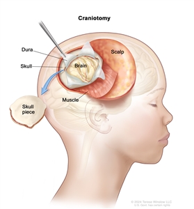 Drawing of a craniotomy showing a section of the scalp that has been pulled back to remove a piece of the skull; the dura covering the brain has been opened to expose the brain. The layer of muscle under the scalp is also shown.