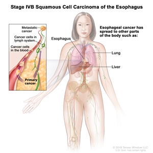 Stage IVB squamous cell carcinoma of the esophagus; drawing shows other parts of the body where esophagus cancer may spread, including the lung and liver. An inset shows cancer cells spreading from the esophagus, through the blood and lymph system, to another part of the body where metastatic cancer has formed.