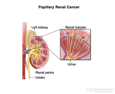 Papillary renal cancer; drawing showing the left kidney, renal pelvis, and ureter. Also shown is a pullout of the renal tubules, which is where urine is made.