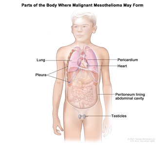 Drawing shows parts of the body where malignant mesothelioma may form, including the pleura (the tissue that lines the chest cavity and covers the lungs), the pericardium (the tissue that surrounds the heart), the peritoneum (the tissue that lines the abdomen and covers most of the organs in the abdomen), and the testicles. The heart and lungs are also shown.