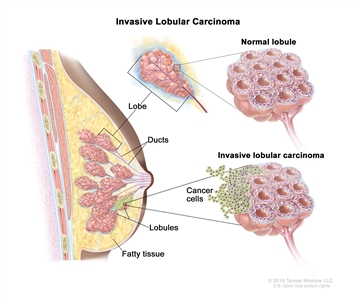 Invasive lobular carcinoma of the breast; drawing shows a lobe, ducts, lobules, and fatty tissue in a cross section of the breast. There are also three separate pullouts showing a normal lobe, a normal lobule, and a lobule with invasive lobular carcinoma and cancer cells spreading outside it.