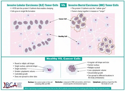 Graphic showing the differences between invasive lobular carcinoma tumor cells and invasive ductal carcinoma cells.